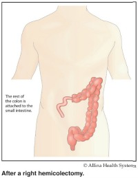 right-hemicolectomy-after200x259